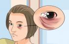 Как замаскировать синяк под глазом от удара: косметика, рекомендации и особенности